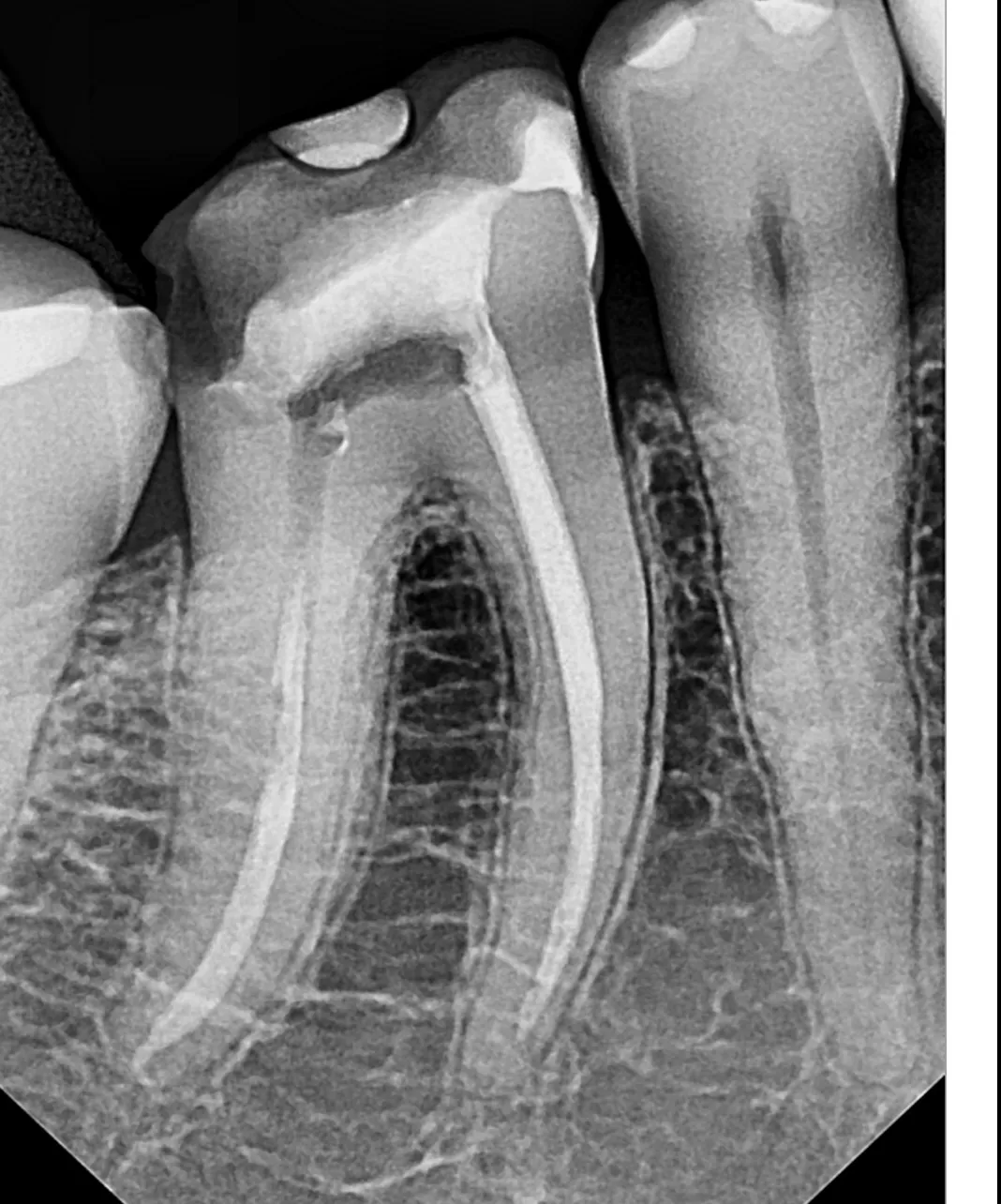 Periapical