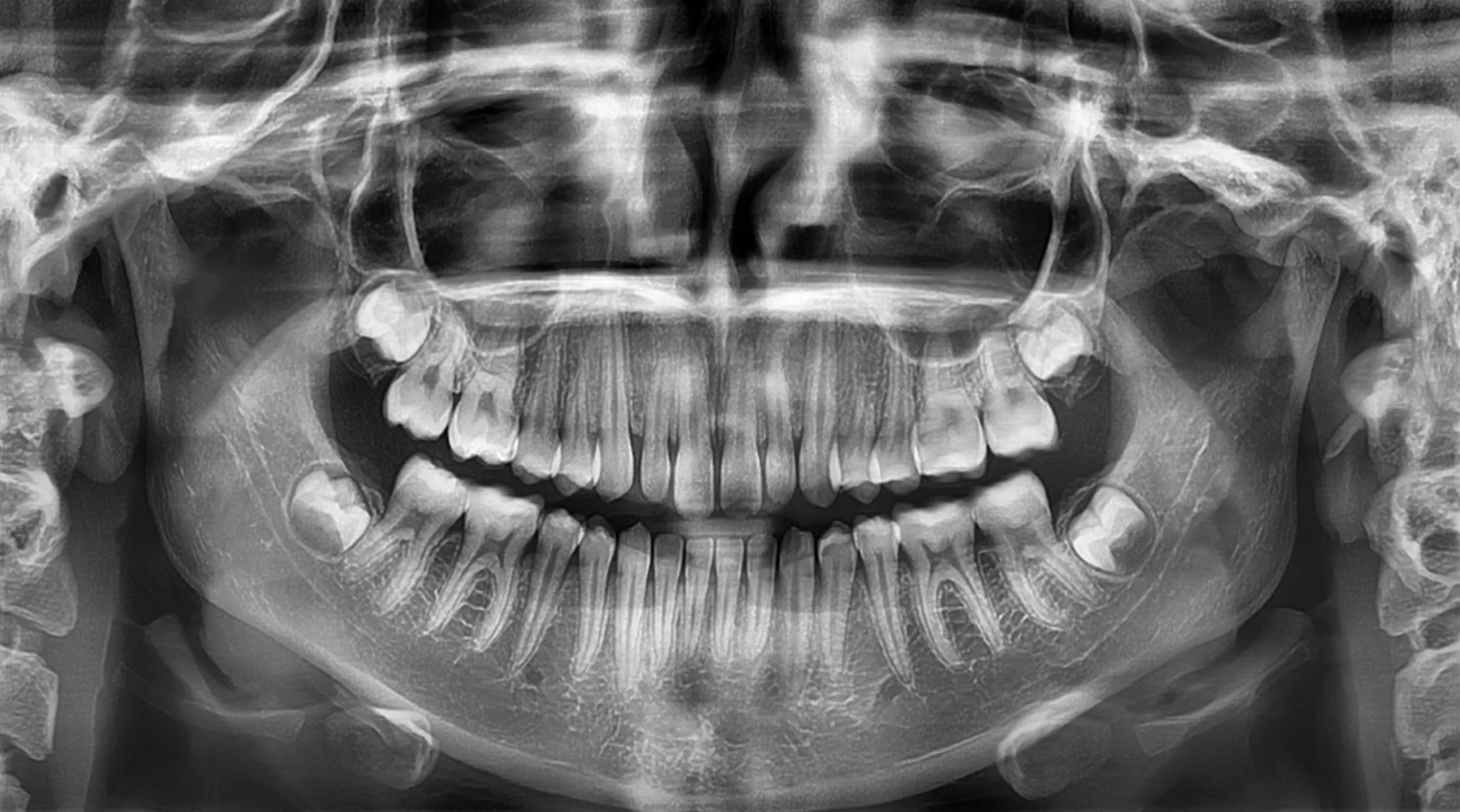 Radiografía panorámica dental en alta definición